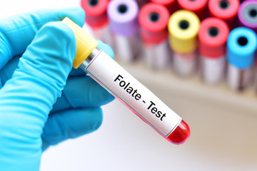Test tube with blood sample for folate test, anemia disease diagnosis
