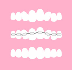 Vector illustration of the stages of orthodontic treatment braces on teeth . Teeth before and after braces on pink background in flat cartoon style.