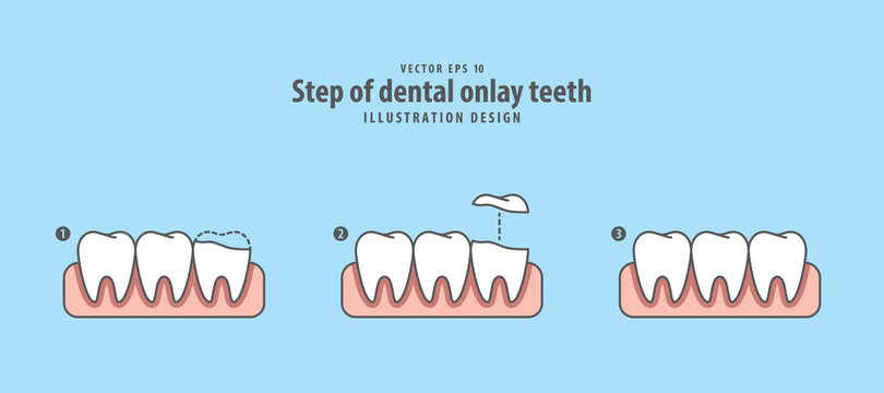 Step of dental onlay tooth illustration vector on blue background. Dental concept.