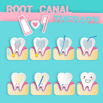 tooth with root canal therapy