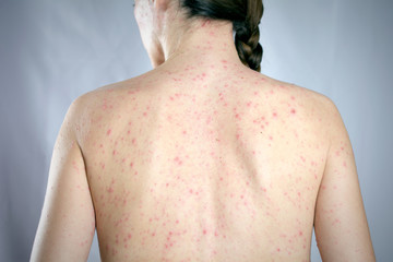 epidemic viral infection psoriasis concept. girls back skin rashes - obrazy, fototapety, plakaty