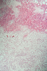 Poly Nephritis, Gewebe unter dem Mikroskop 100x