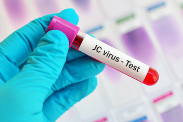 Blood sample for JC virus test, diagnosis for progressive multifocal encephalopathy (PML) disease