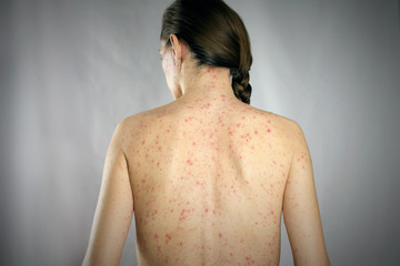 treatment eczema  concept. girls back skin rashes - obrazy, fototapety, plakaty