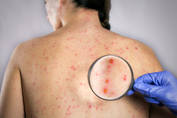 medical research chickenpox viral infection concept. girls back skin rashes