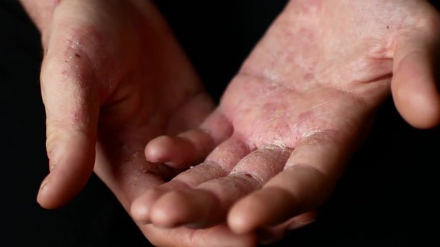 The man scratches his hands. Very itchy fingers, psoriasis.