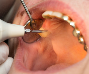 A dentist makes teeth to a woman