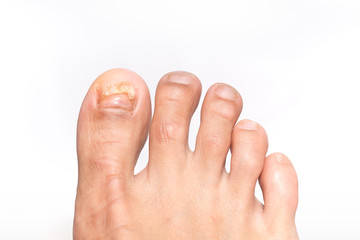 footNail fungus on a toenail on white background.
close up finger toe injured to lose nail.