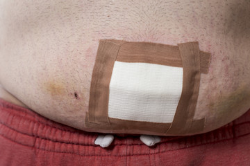 Patient's wound bandaged with sterile gauze