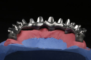 metal skeleton for dental prosthesis, shown on the model