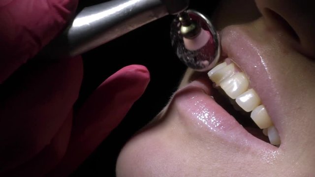 Dentist making tooth cleaning for patient in dental clinic