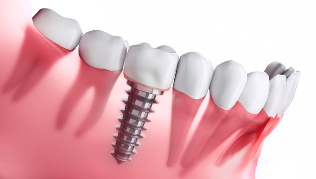Zahnimplantat im Unterkiefer