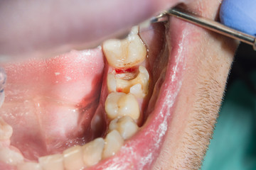 Treatment of the roots of the tooth. Sealing and cleaning a carious human tooth close-up of a macro. The concept of innovation and technology in modern endodontic