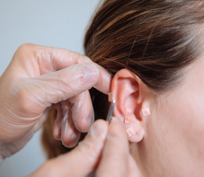 doctor putting acupuncture needles in the ear