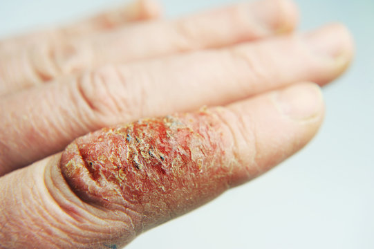 Atopic dermatitis (AD), also known as atopic eczema, is a type of inflammation of the skin (dermatitis) at foot.