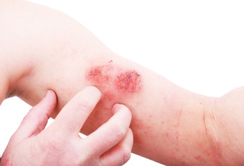 Atopic dermatitis (AD), also known as atopic eczema, is a type of inflammation of the skin (dermatitis) at foot.