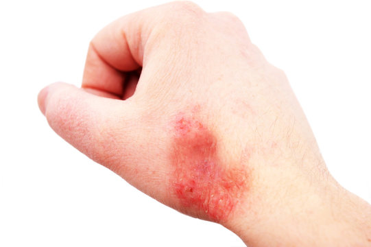 Atopic dermatitis (AD), also known as atopic eczema, is a type of inflammation of the skin (dermatitis) at foot.