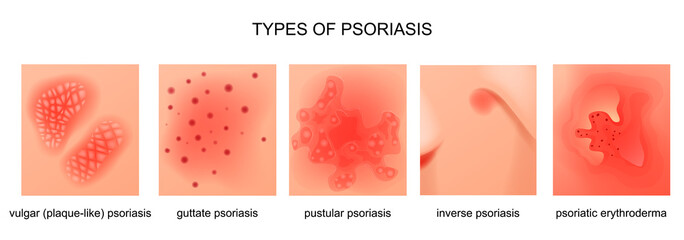 types of psoriasis
