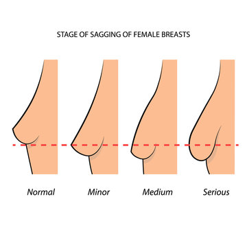Stage of sagging of female breasts, information graphic. Vector illustration.