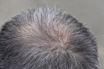 A middle-aged man begins to lose the hair