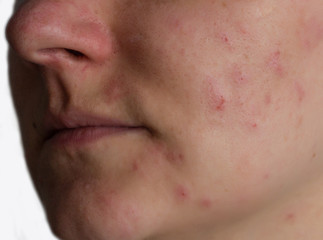 Acne on the face of a girl, close-up