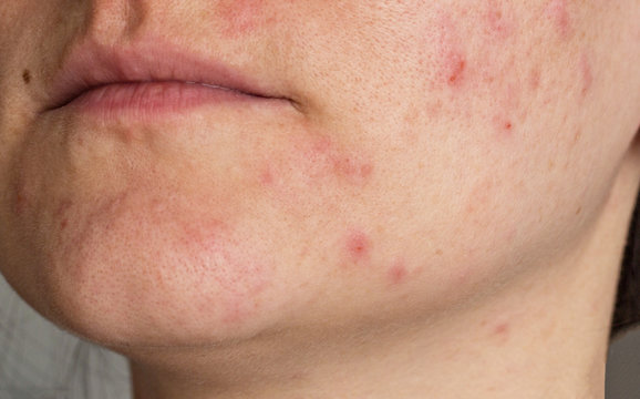 Acne on the face of a girl, close-up
