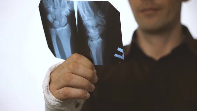 A man with a broken right hand looks at a picture of Rengen. A fracture of the hand led to disability. Health insurance. Close-up