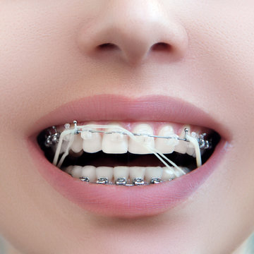Closeup Dental Brackets with Rubber Elastic Band. Open Female Mouth with Self-ligating Braces. Orthodontic Treatment.