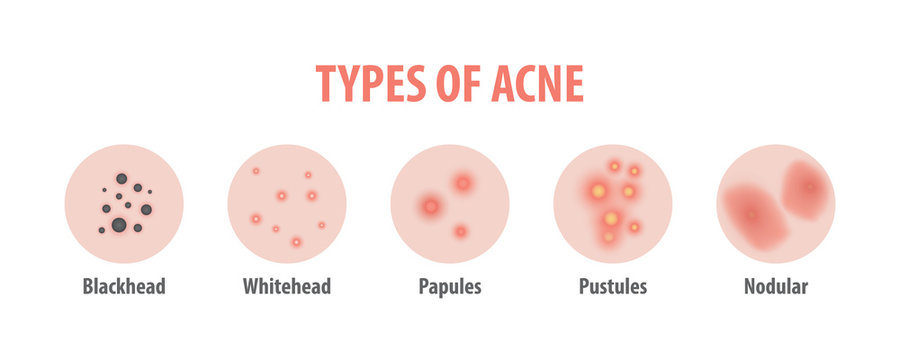 Types of acne diagram illustration vector on white background, Beauty concept.