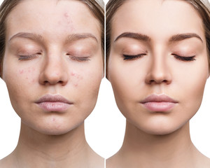 Woman with acne before and after treatment.
