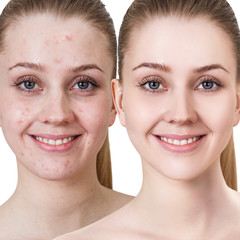 Young woman with acne before and after treatment. - 198940557