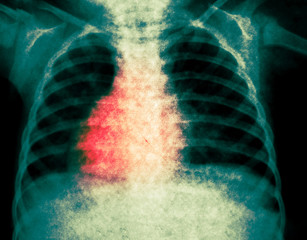 X ray of chest and lungs