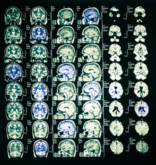 mri scan or magnetic resonance image of head and brain scan.