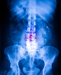 Xray of stomah and pelvis section