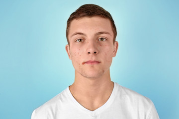Young man with acne problem on color background