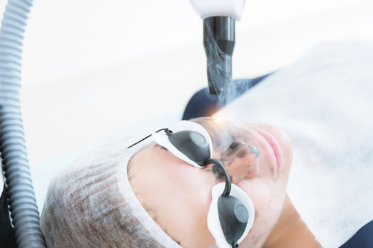 Close-up carbon face peeling procedure. Laser pulses clean skin of the face. Hardware cosmetology treatment. Process of photothermolysis, warming the skin, laser carbon peeling. Facial skin