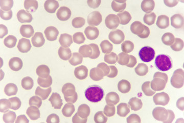 Blood smear of chronic lymphocytic leukemia (CLL), analyze by microscope
