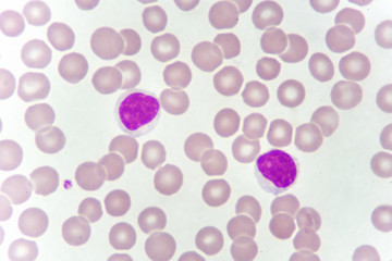 Lymphocyte cells (white blood cell) in blood smear, analyze by microscope
