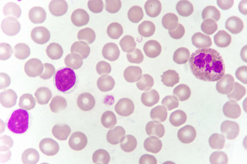 Blood smear of chronic lymphocytic leukemia (CLL), analyze by microscope
