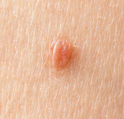 Fototapeta premium birthmark on skin