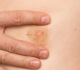 Ringworm on the body