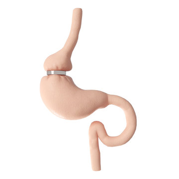 3d rendered medically accurate illustration of a gastric banding