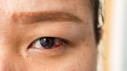 woman with problem on red eye infection