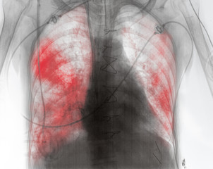 X-ray image of patient with lung inflammation in the early post-surgery period