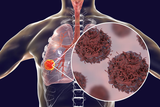 Lung cancer, tumor inside lung and close-up view of pulmonary cancer cells, illustration