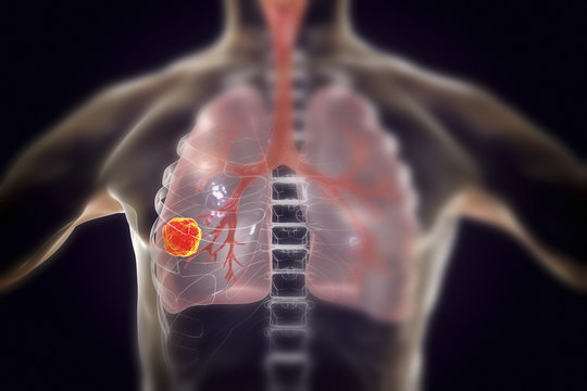 Lung cancer, medical concept, 3D illustration showing cancerous tumor inside human lung