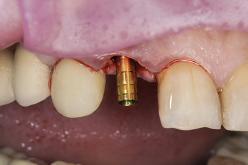 bright abutment for the front tooth before installing the crown