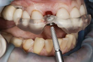 professional installation of high-quality dental implant through a special template