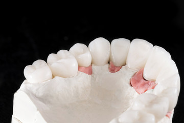 ceramic crowns and fitting dental model, shot at an angle on a black background