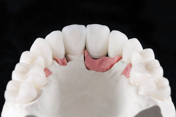 ceramic crowns and fitting dental models on a black background